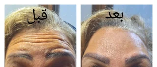 بوتاکس پیشانی