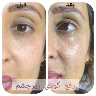 فیلر زیرچشم