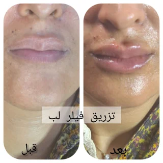 فیلر لب نچرال