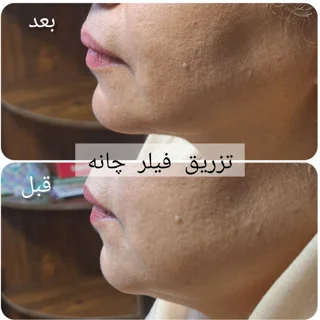 فیلر چانه