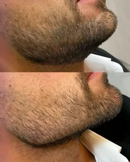 کانتورینگ صورت ، زاویه فک