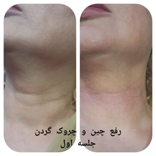 کربوکسی تراپی